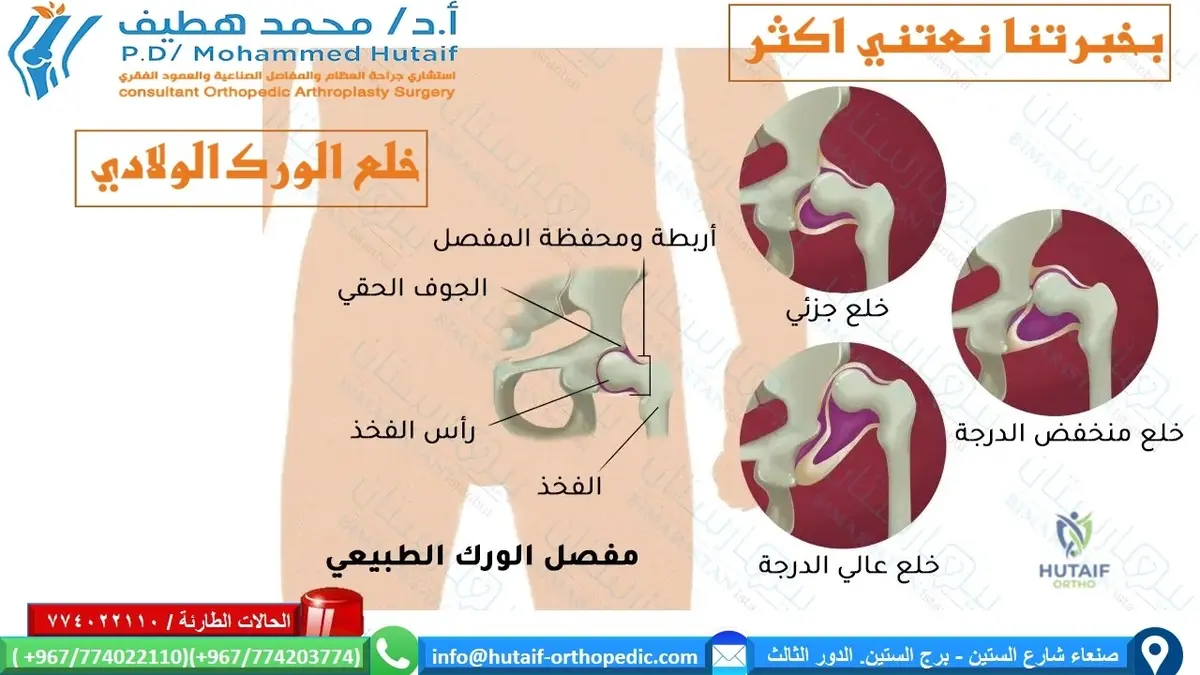فهم درجات خلع الورك الولادي: دليلك الشامل لحالتك