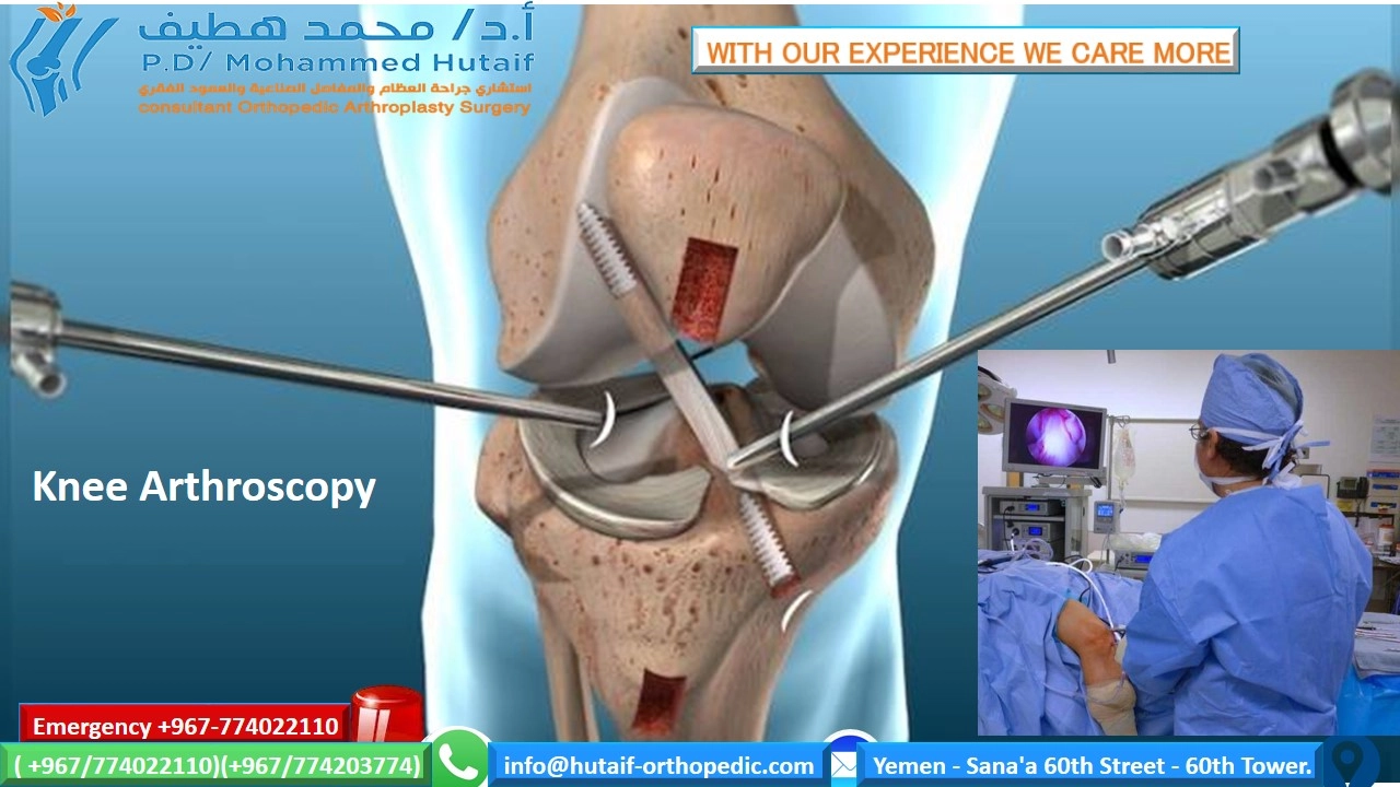 Knee Arthroscopy: Understand the Procedure with Photos