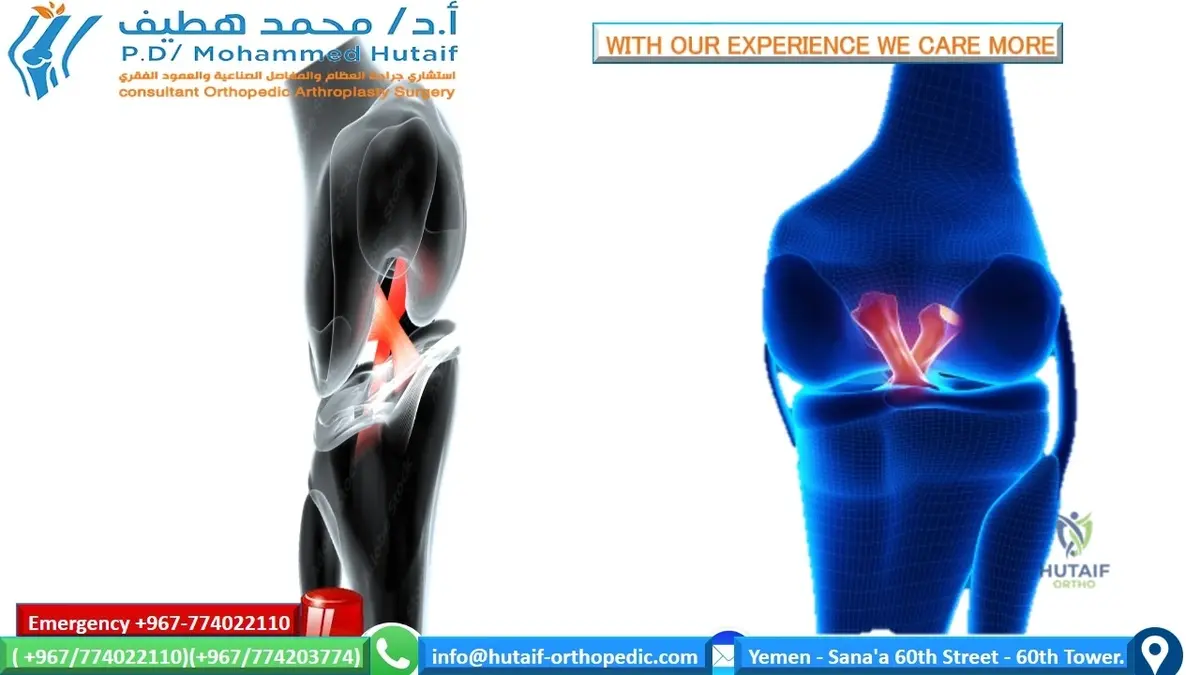 Anterior Cruciate Ligament (ACL): Comprehensive Guide to Anatomy, Biomechanics & Epidemiology