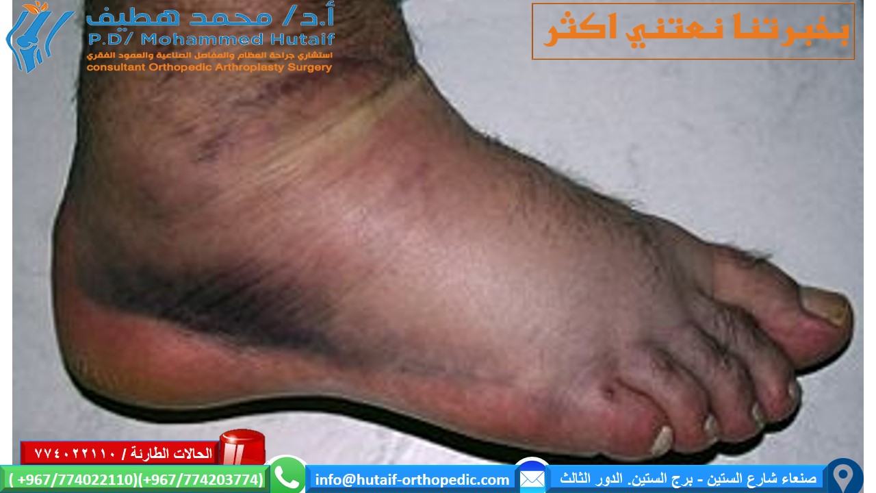 كسور الكاحل العلامات والأعراض