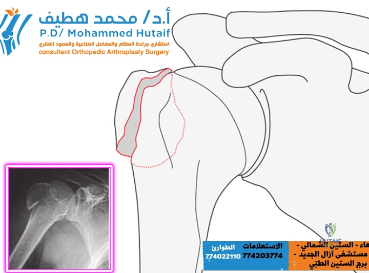 Extra Articular 2-Part, Greater Tuberosity, Non Displaced
