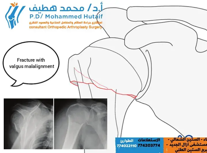 اكتشف: متلازمة الكتف والعمود الفقري.. علاج فعال!