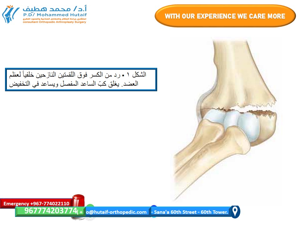 الرد المغلق والتثبيت الجلدي الفعال لكسور فوق اللقمتين في عظم العضد