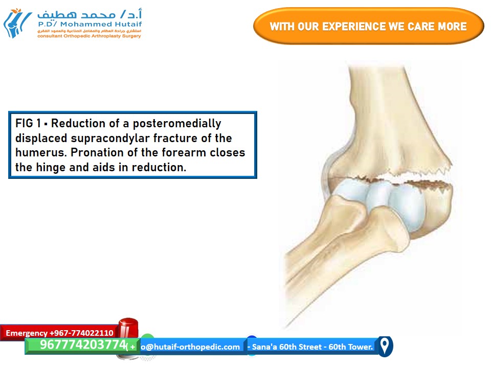 Humerus Closed Reduction: Supracondylar Fracture Pinning Guide