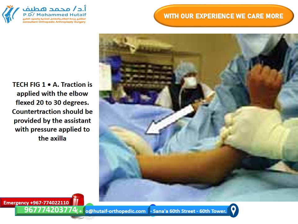 Closed Reduction Supracondylar Fractures: A Step-by-Step Guide