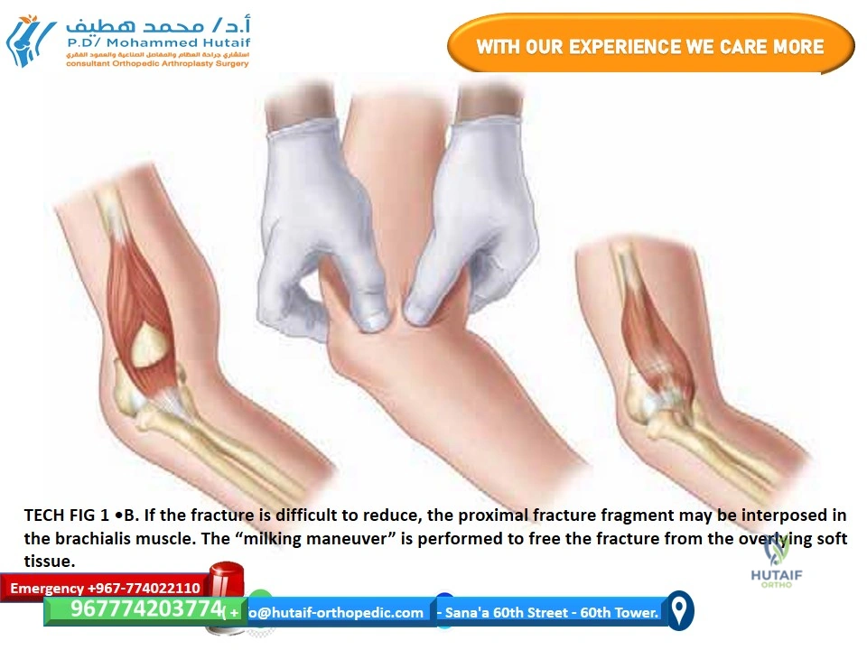 Illustration of closed reduction supracondylar - Dr. Mohammed Hutaif