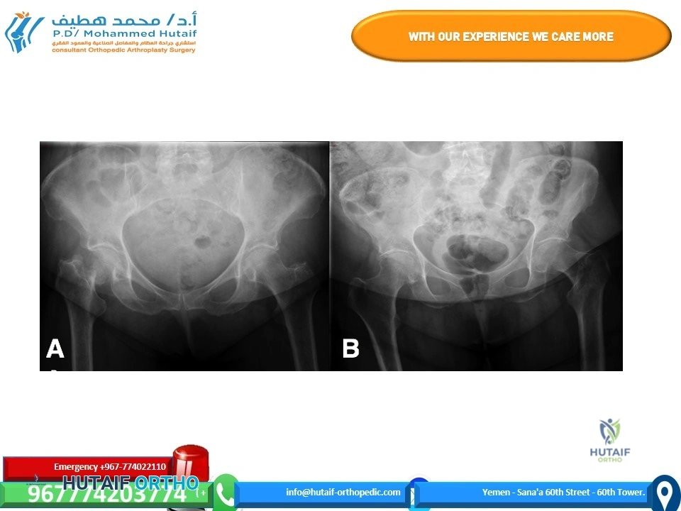 Pediatric Orthopedics: OI & SMA Board Review MCQs