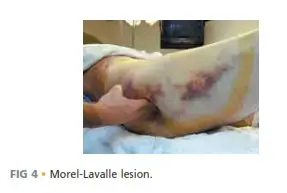 اكتشف: أسرار الساق المدببة.. طريقك نحو صحة العظام!