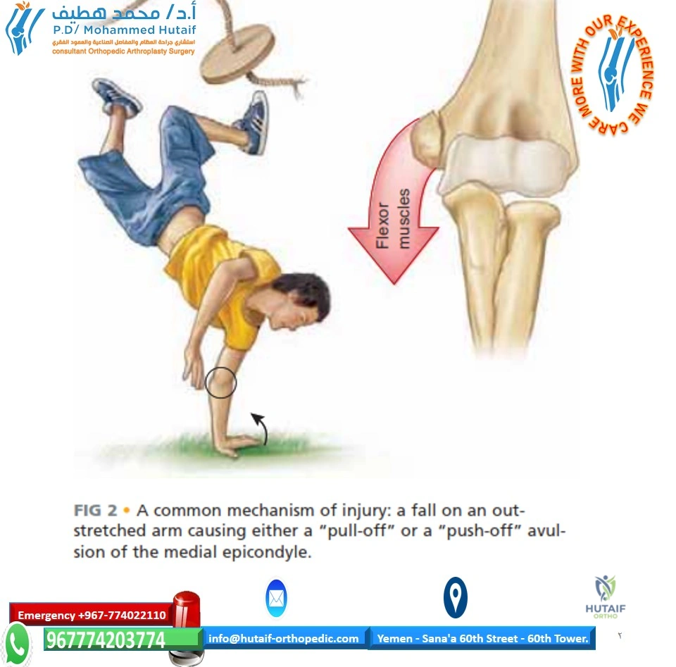 Illustration of medial epi condyle - Dr. Mohammed Hutaif