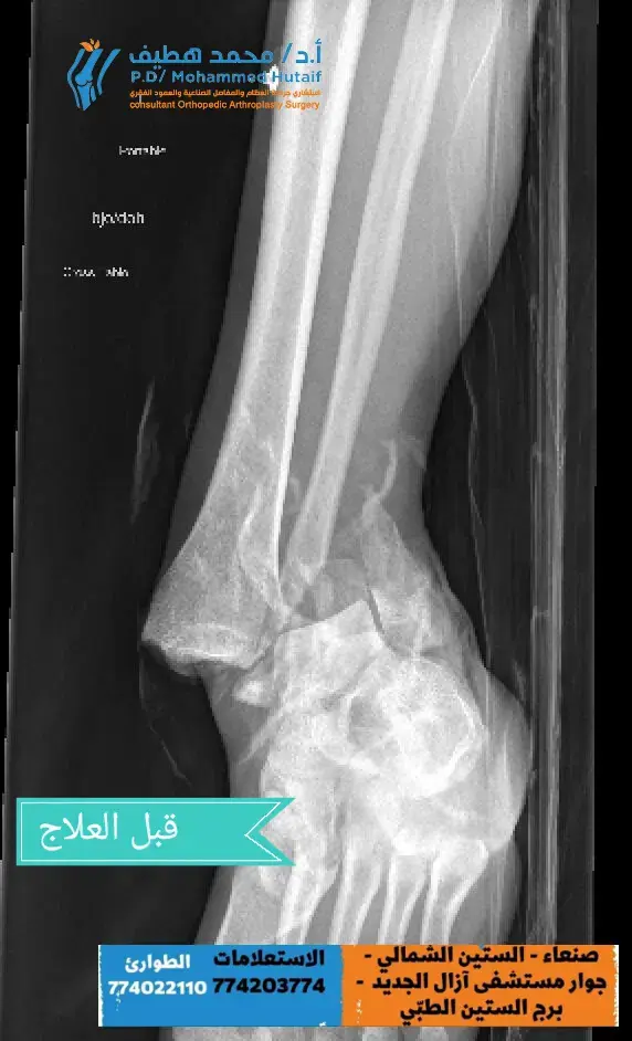 افضل دكتور عظام في صنعاء, دكتور عظام اطفال, دكتور عمود فقري صنعاء, جراحة العظام والمفاصل, دكتور محمد هطيف, مستشفى عظام في صنعاء