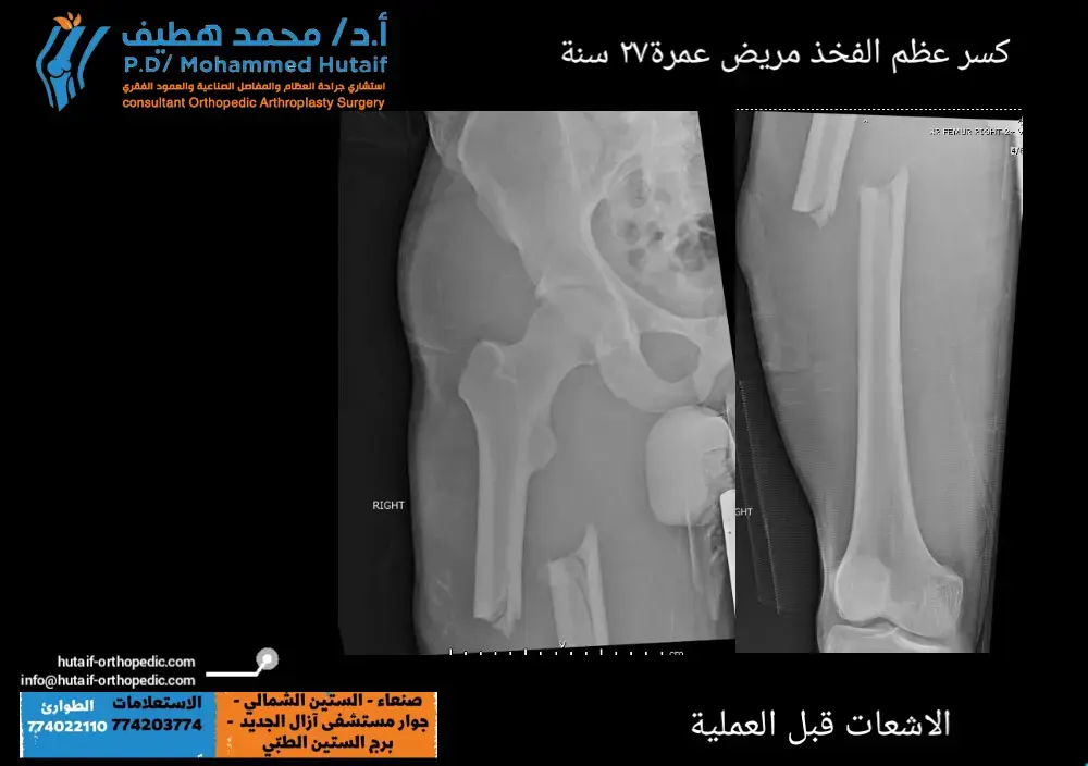 جدّد مفصلك: تقنيات متطورة للإصلاح بالأسمنت!