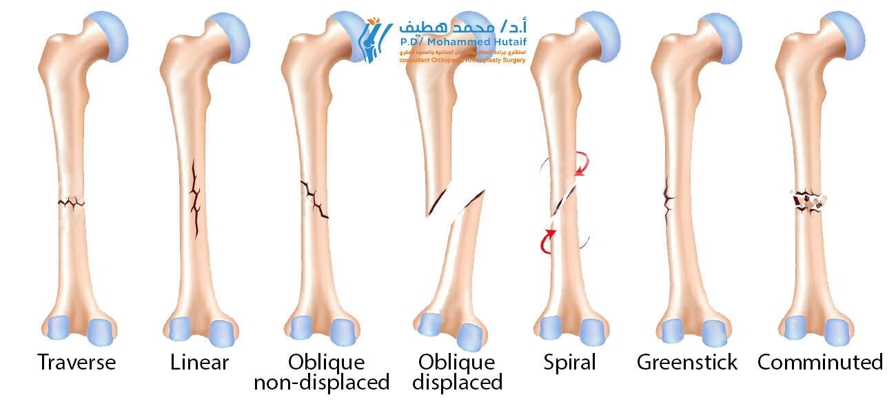 Broken Bones & Bone Fractures: Your Guide to Causes, Types & Recovery