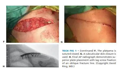 دليلك الشامل لتسكين آلام الكتف بعد الجراحة
