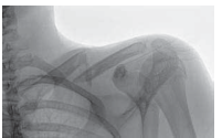 Clavicle Tech Fig: Plate Fixation for Lasting Repair
