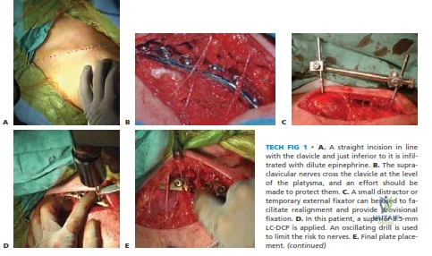 Illustration of clavicle tech fig - Dr. Mohammed Hutaif