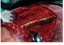 Illustration of clavicle tech fig - Dr. Mohammed Hutaif