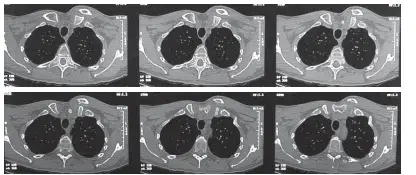 اكتشف متلازمة النفق الرسغي: دليلك الشامل لتخفيف الألم!