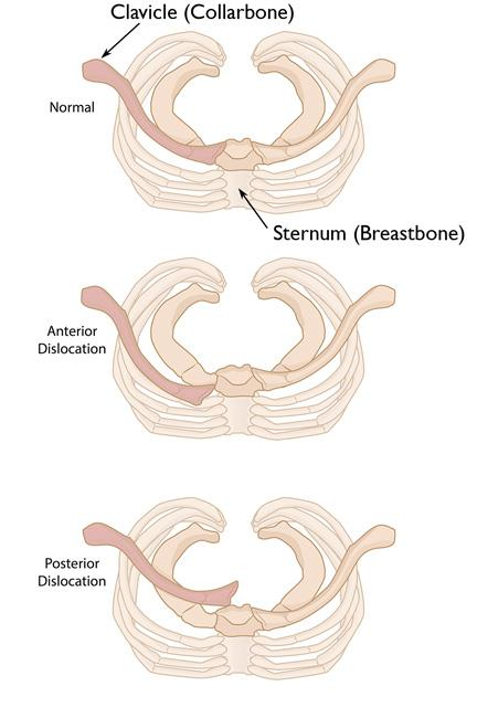 Illustration of sc joint disorders - Dr. Mohammed Hutaif