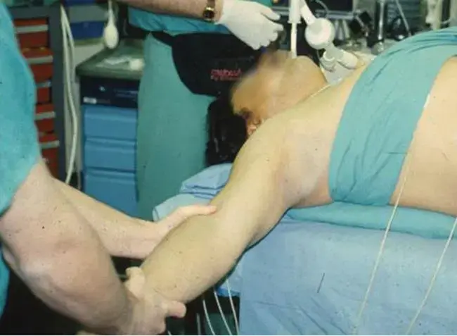 استبدال مفصل الورك: دليل شامل للسيقان الفخذيه غير المثبته