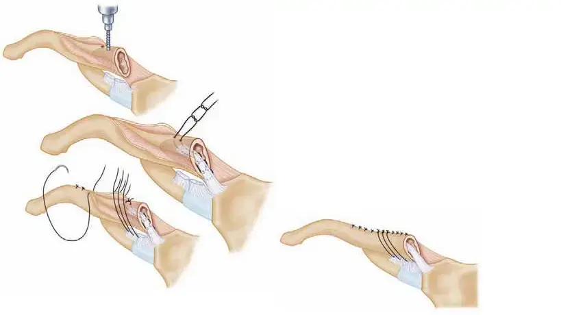 اكسر حاجز الخوف: دليلك الشامل لكسور الترقوه من التشخيص للتعافي