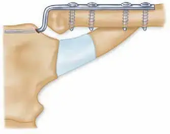 أتقن عزم المساحة الثاني والعزم القطبي بجراحة العظام: دليل FRCS