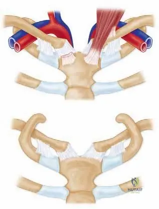 Illustration of clavicle excision and sternoclavicular - Dr. Mohammed Hutaif