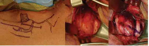 يجب على المرضى فهم تكلفة جراحة الورك: دليل شامل لأسعارها.