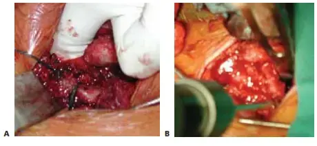 وداعًا للألم: دليلك الشامل لجراحة مفصل الورك التصحيحية!