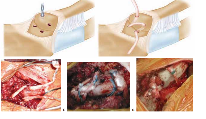 Illustration of clavicle excision and sternoclavicular - Dr. Mohammed Hutaif
