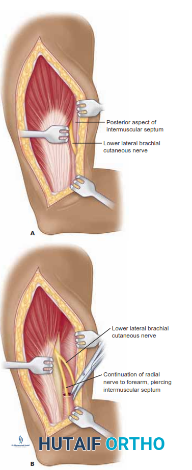 Illustration of lower lateral brachial - Dr. Mohammed Hutaif