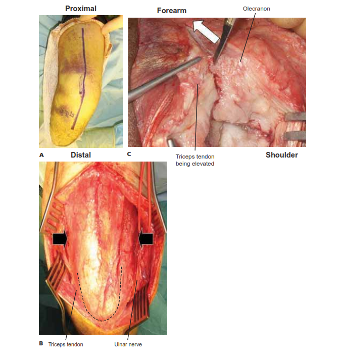 Surgical Approaches to the Elbow: Master Each Technique