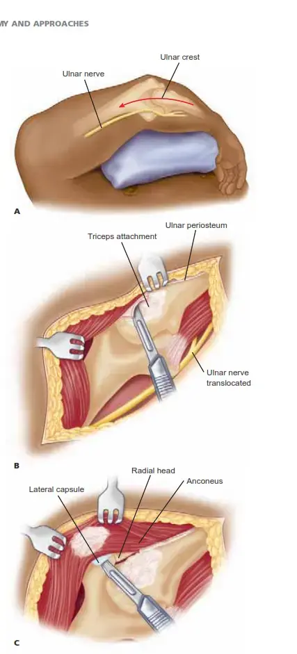 كسور الظنبوب إلى السطح المفصلي: أسرار التثبيت بالصفائح