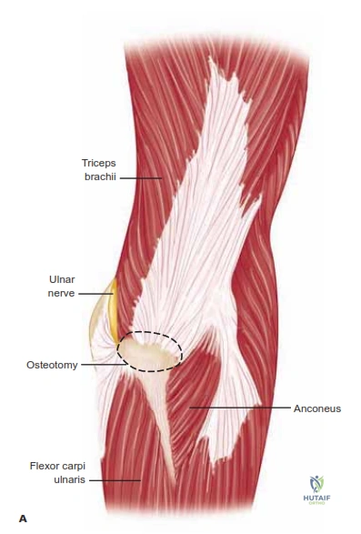 Illustration of surgical approaches elbow - Dr. Mohammed Hutaif