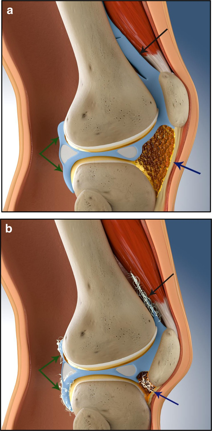 Regain Mobility: Surgical Techniques for Posttraumatic Knee Stiffness