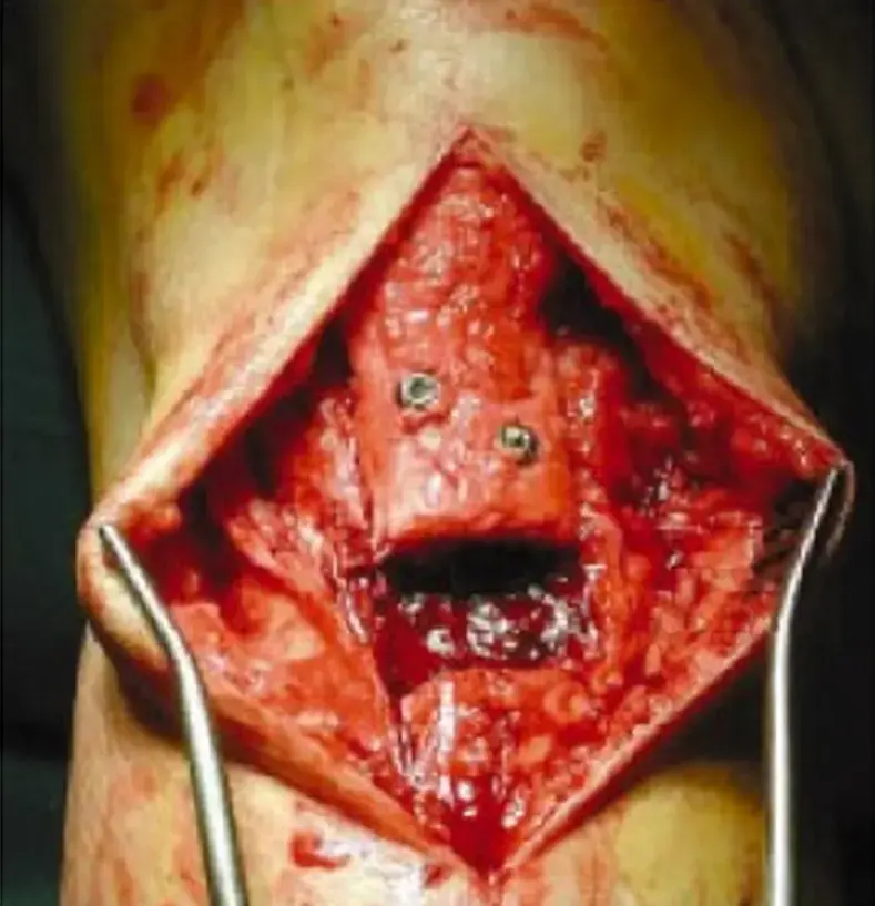 إعادة ترميم مفصل الورك: حلول مبتكرة لنقص عظام الحُق الشديد