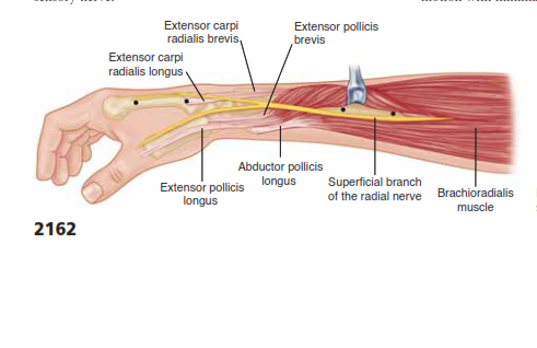 Effective K-Wire Fixation for Distal Radius Fractures Without External Fixation