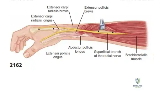 Effective K-Wire Fixation for Distal Radius Fractures Without External Fixation