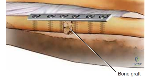 The two bones of the forearm form a functional unit, with the axis of rotation extending from the radiocapitellar joint to the distal radioulnar joint.
