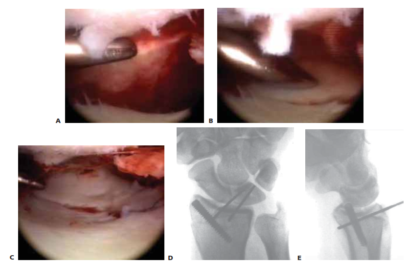 Achieve Perfect Reduction: Managing Radial Styloid Fractures with Arthroscopy