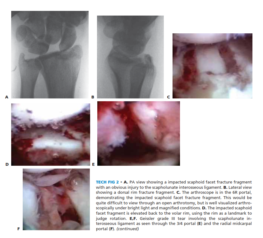 TECH FIG 1 • A. Arthroscopic view of the patient whose radiographs are seen in Figure 1. The arthroscope is in the 6R portal looking across the wrist, and a blunt trochar is in the 3/4 portal. The displaced radial styloid fragment is well visualized. B. A combination of joysticks inserted into the radial styloid fragment and a trochar inserted into the 3/4 portal allows anatomic reduction of the displaced radial styloid fragment and radiocarpal joint. C. The radial styloid fragment is anatomically reduced \(with no residual rotation\) and stabilized. D. PA view demonstrating anatomic reduction to the radial styloid fragment. Headless cannulated screws are used, if possible, to avoid soft tissue irritation. E. Lateral view showing anatomic restoration to the radial styloid fragment and restoration of the carpus in line with the radiu