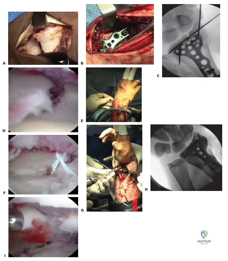 TECH FIG 1 • A.  Arthroscopic view  of the patient whose radiographs are  seen in Figure 1. The arthroscope is in the 6R portal  looking across  the wrist,  and a blunt trochar is in the 3/4 portal. The displaced radial styloid fragment is well  visualized. B.  A combination of  joysticks  inserted into the radial styloid fragment and a  trochar inserted into the 3/4  portal allows anatomic reduction of the displaced radial styloid fragment and radiocarpal joint. C.  The radial styloid fragment is anatomically reduced \(with no  residual rotation\) and stabilized. D.  PA view  demonstrating anatomic reduction to the radial styloid fragment. Headless cannulated screws  are  used, if possible, to avoid soft  tissue irritation. E.  Lateral view  showing anatomic restoration to the radial styloid fragment and restoration of the carpus in line  with the radiu