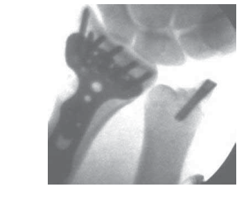 Understand & Treat Styloid Fractures Ulnar: Expert Surgical Guide
