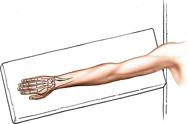 Mastering Dorsal Wrist Approach: The Side of Lister Tubercle Revealed