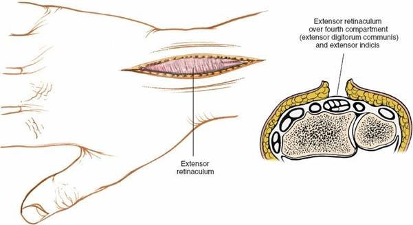 igure 5-3 Skin flaps are developed, and the extensor retinaculum is visualized in the deeper portion of the wound. Cross section reveals the approach to the fourth tunnel, which contains the extensor digitorum communis and the extensor indicis proprius.