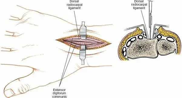 دليلك الشامل لـ جراحة استبدال مفصل الورك الهجين