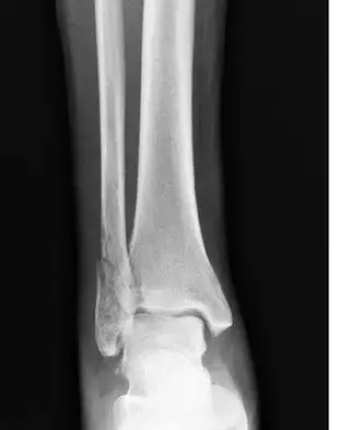 المفصل بالرنين المغناطيسي: أسرار تشخيص آلام الكتف بدقة