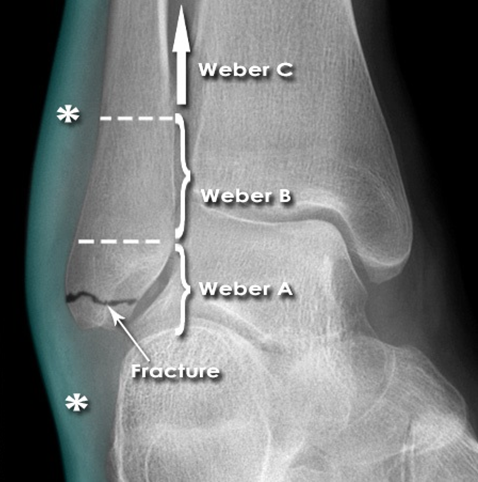 Ankle Fractures Dislocations: Expert Diagnosis, Treatment & Outcomes