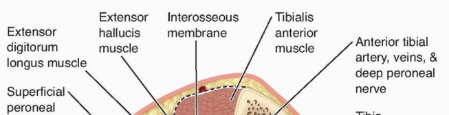 Illustration of compartment syndrome chronic - Dr. Mohammed Hutaif