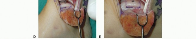 Illustration 19 for Unlock Healing: Medial Malleolar Osteotomy for Talus OLT Allografts
