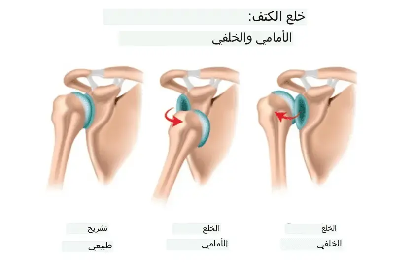 اكتشف: أنواع كسور الكاحل، علاجها، وطرق التعافي السريع